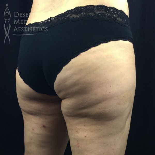 fat in underbutt of female patient before coolsculpting