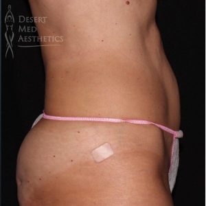 after coolsculpting on female patient's abdomen right profile view case 5