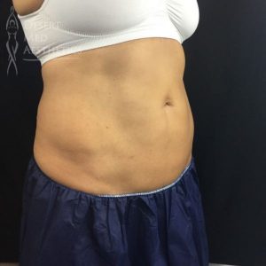 lower abdomen after coolsculpting case 4 right oblique