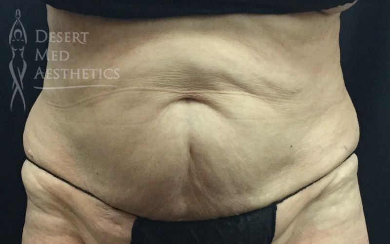 After CoolSculpting on Palm Desert patient's abs closeup