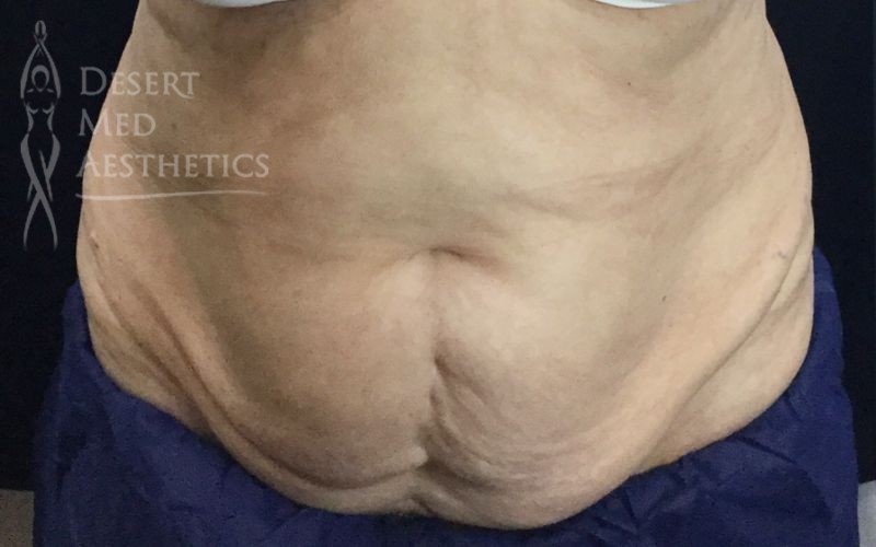 Before CoolSculpting on Palm Desert patient's abs closeup