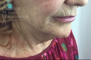lower face and neck before threads treatment case 1